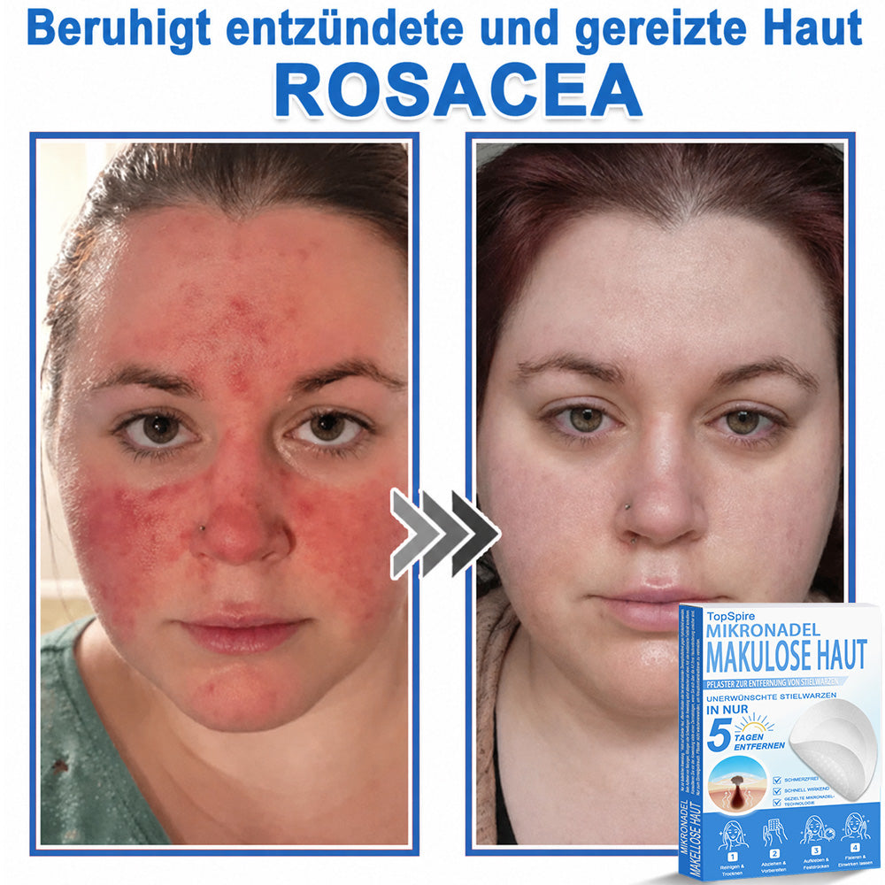 👩‍⚕️TopSpire® 2-in-1 Mikronadel- & Hydrokolloid-Pflaster | Entferner für erhabene Muttermale, Akne, flache Warzen & Hautanhängsel | Verbessert Falten, Narben & Hautunreinheiten | Unsichtbare Stern-Pickelpflaster für Gesicht & Körper