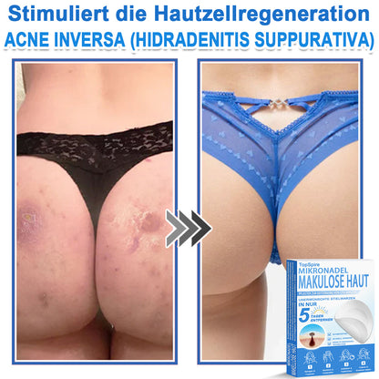 👩‍⚕️TopSpire® 2-in-1 Mikronadel- & Hydrokolloid-Pflaster | Entferner für erhabene Muttermale, Akne, flache Warzen & Hautanhängsel | Verbessert Falten, Narben & Hautunreinheiten | Unsichtbare Stern-Pickelpflaster für Gesicht & Körper