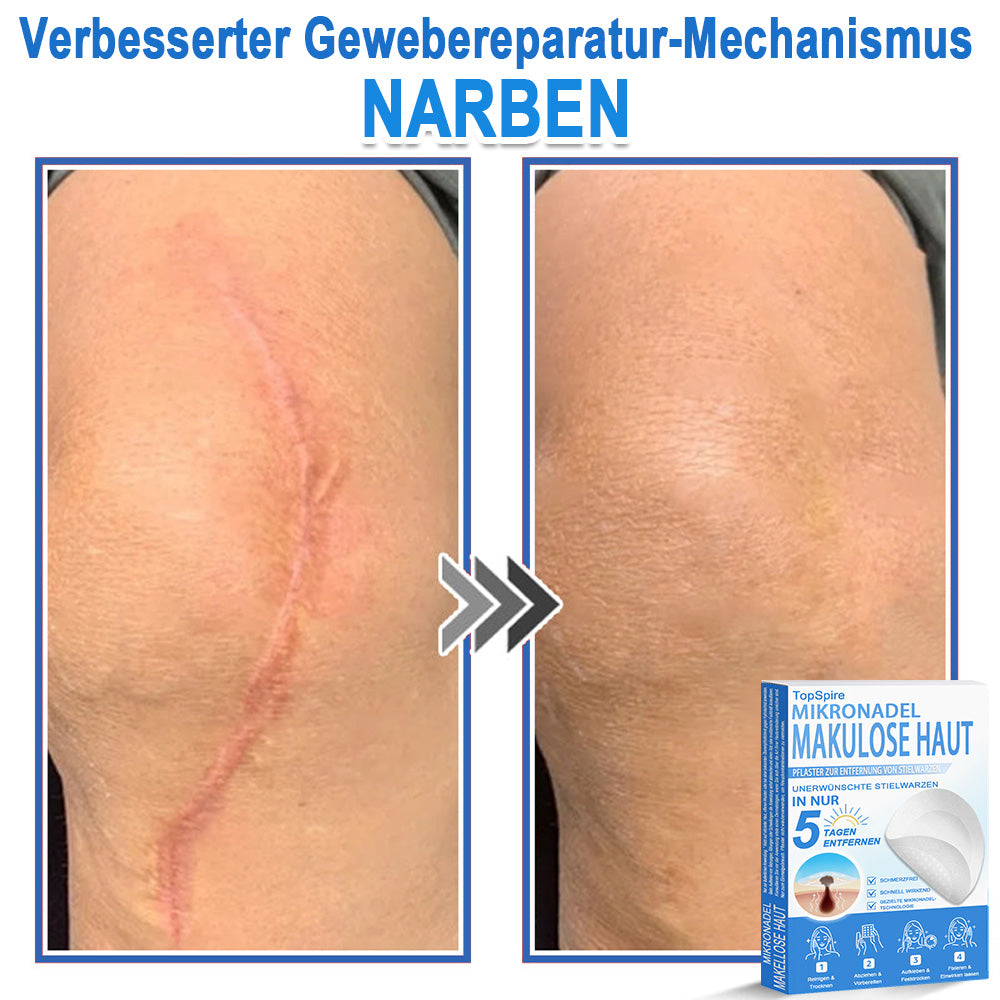 👩‍⚕️TopSpire® 2-in-1 Mikronadel- & Hydrokolloid-Pflaster | Entferner für erhabene Muttermale, Akne, flache Warzen & Hautanhängsel | Verbessert Falten, Narben & Hautunreinheiten | Unsichtbare Stern-Pickelpflaster für Gesicht & Körper