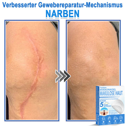 👩‍⚕️TopSpire® 2-in-1 Mikronadel- & Hydrokolloid-Pflaster | Entferner für erhabene Muttermale, Akne, flache Warzen & Hautanhängsel | Verbessert Falten, Narben & Hautunreinheiten | Unsichtbare Stern-Pickelpflaster für Gesicht & Körper