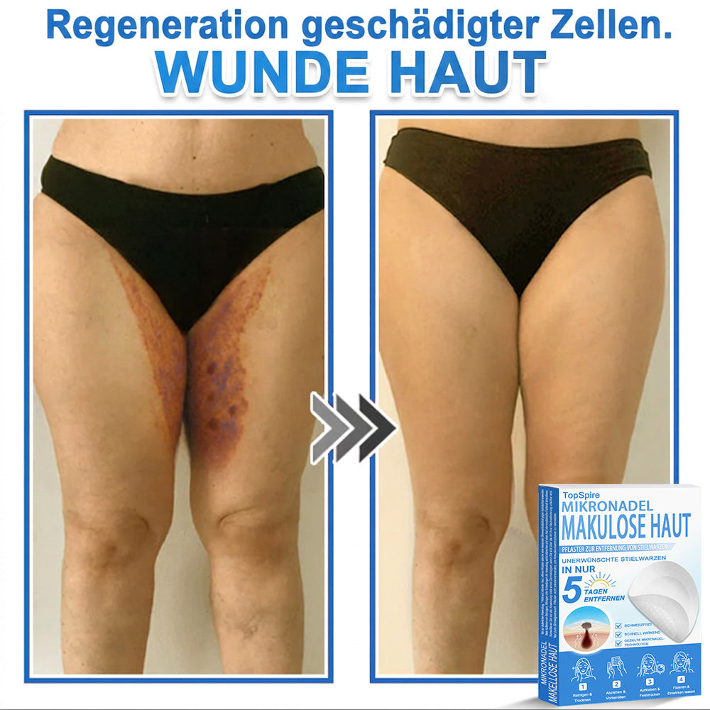 👩‍⚕️TopSpire® 2-in-1 Mikronadel- & Hydrokolloid-Pflaster | Entferner für erhabene Muttermale, Akne, flache Warzen & Hautanhängsel | Verbessert Falten, Narben & Hautunreinheiten | Unsichtbare Stern-Pickelpflaster für Gesicht & Körper