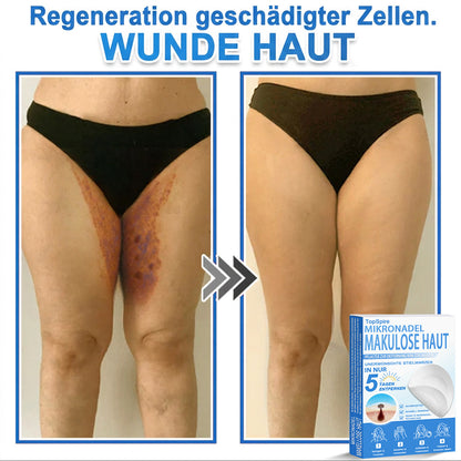 👩‍⚕️TopSpire® 2-in-1 Mikronadel- & Hydrokolloid-Pflaster | Entferner für erhabene Muttermale, Akne, flache Warzen & Hautanhängsel | Verbessert Falten, Narben & Hautunreinheiten | Unsichtbare Stern-Pickelpflaster für Gesicht & Körper