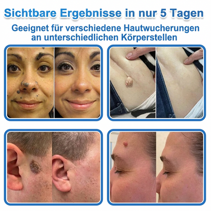 👩‍⚕️TopSpire® 2-in-1 Mikronadel- & Hydrokolloid-Pflaster | Entferner für erhabene Muttermale, Akne, flache Warzen & Hautanhängsel | Verbessert Falten, Narben & Hautunreinheiten | Unsichtbare Stern-Pickelpflaster für Gesicht & Körper