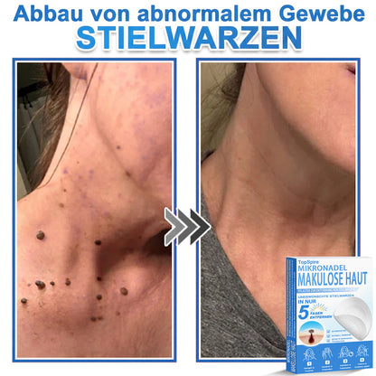 👩‍⚕️TopSpire® 2-in-1 Mikronadel- & Hydrokolloid-Pflaster | Entferner für erhabene Muttermale, Akne, flache Warzen & Hautanhängsel | Verbessert Falten, Narben & Hautunreinheiten | Unsichtbare Stern-Pickelpflaster für Gesicht & Körper