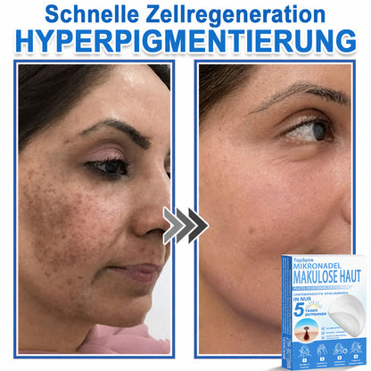 👩‍⚕️TopSpire® 2-in-1 Mikronadel- & Hydrokolloid-Pflaster | Entferner für erhabene Muttermale, Akne, flache Warzen & Hautanhängsel | Verbessert Falten, Narben & Hautunreinheiten | Unsichtbare Stern-Pickelpflaster für Gesicht & Körper