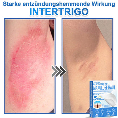 👩‍⚕️TopSpire® 2-in-1 Mikronadel- & Hydrokolloid-Pflaster | Entferner für erhabene Muttermale, Akne, flache Warzen & Hautanhängsel | Verbessert Falten, Narben & Hautunreinheiten | Unsichtbare Stern-Pickelpflaster für Gesicht & Körper