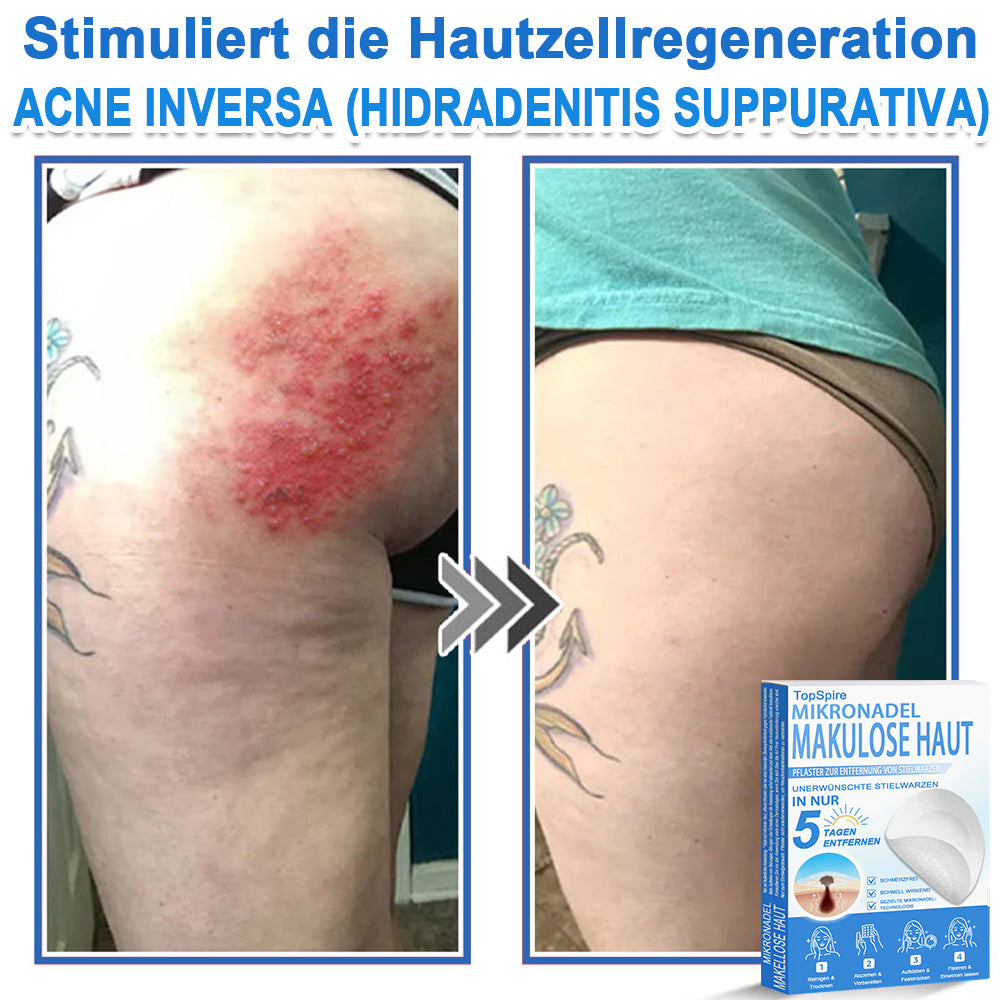 👩‍⚕️TopSpire® 2-in-1 Mikronadel- & Hydrokolloid-Pflaster | Entferner für erhabene Muttermale, Akne, flache Warzen & Hautanhängsel | Verbessert Falten, Narben & Hautunreinheiten | Unsichtbare Stern-Pickelpflaster für Gesicht & Körper