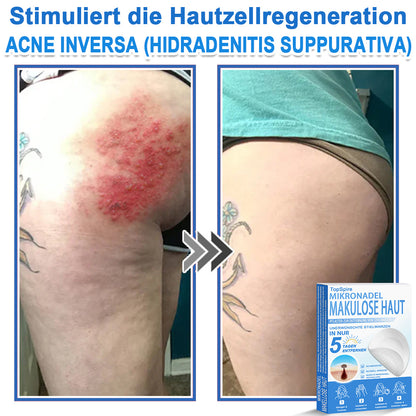 👩‍⚕️TopSpire® 2-in-1 Mikronadel- & Hydrokolloid-Pflaster | Entferner für erhabene Muttermale, Akne, flache Warzen & Hautanhängsel | Verbessert Falten, Narben & Hautunreinheiten | Unsichtbare Stern-Pickelpflaster für Gesicht & Körper